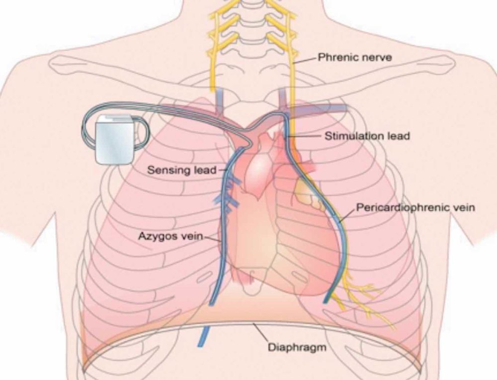 Treating Narcolepsy including Xyrem, Modafinil Adelaide Sleep
