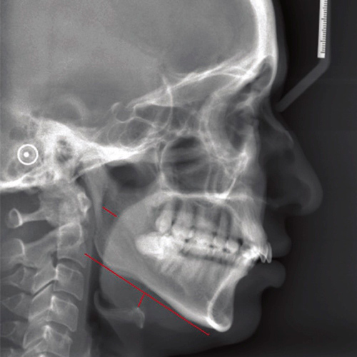 Sleep disorder - Obstructive Sleep Apnoea (OSA)